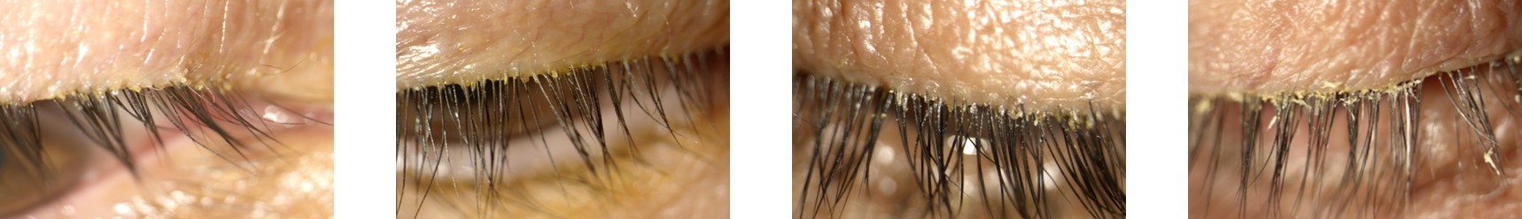 https://cdn.kscope.io/02f952dc0d900b3202cd4f43f0f0253e-Figure 2 Eyelids with Blepharitis.jpg