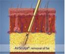 https://cdn.kscope.io/8c491391a96d3b9fab14697ed2273c51-5. Fat Removal Process.jpg
