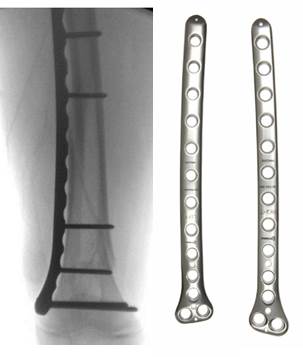 [MISSING IMAGE: t1702092_img-pedilocfemur.jpg]